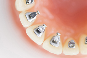 リンガルブラケット